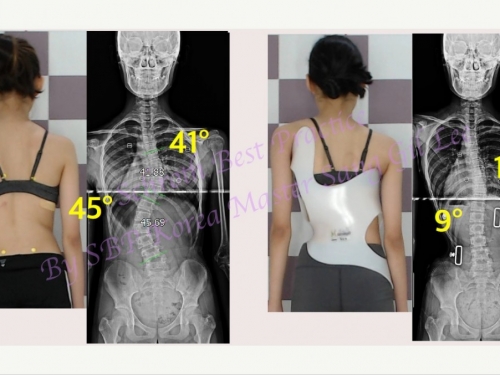 청소년 척추측만증